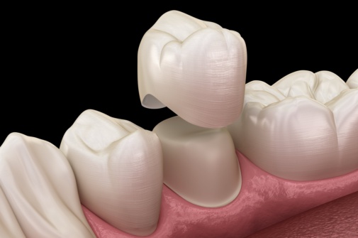 Understanding Our Crown and Bridge Process