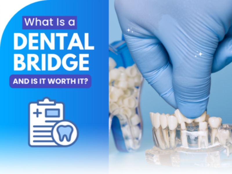 What is a Dental Bridge and is it Worth It?